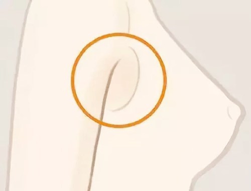 副乳有什么危害吗